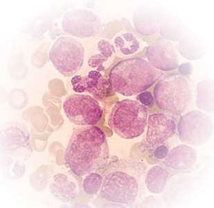 leukemia cells